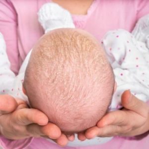 psoriasis cheveux chez le bébé